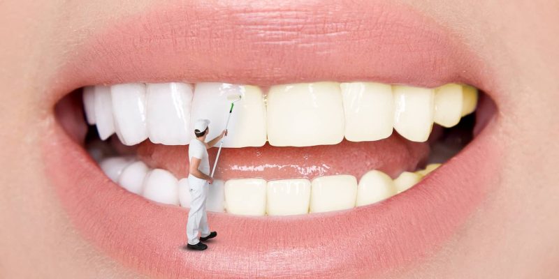 ציפוי ננו-קרמי לשיניים: מה זה אומר ולמי זה מתאים?