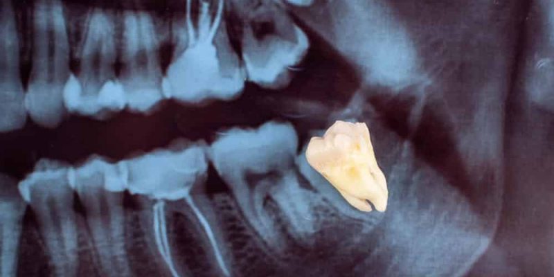 הקשר בין עקירת שן בינה ויישור שיניים